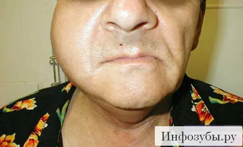 як лікувати флюс в домашніх умовах