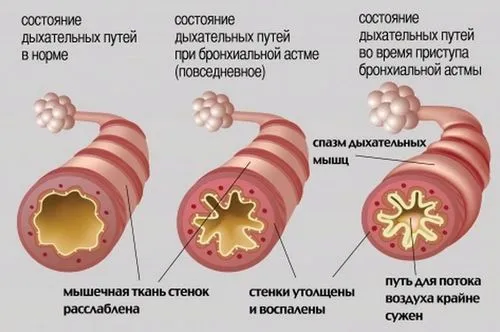 хвороби новонароджених і дітей до року