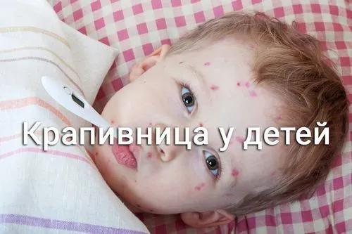 як лікувати дитячу кропивницю