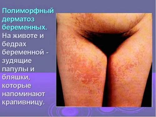 Дерматоз вагітних опис