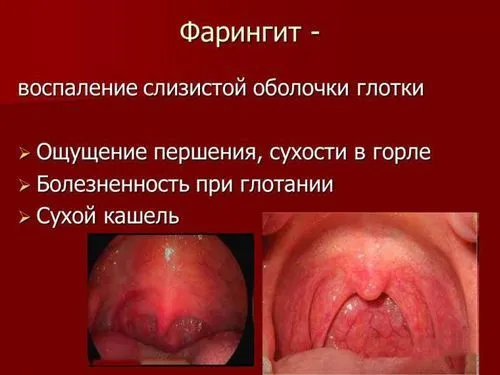 фарингіт симптоми лікування як лікувати фарингіту у дорослих в домашніх умовах хронічний гострий і ліками ознаки алергічний атрофічний фото горла захворювання вірусний причини гнійний форум ніж хвороба температура при фарингіті призначають виглядає
