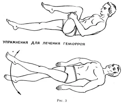 як лікувати геморой в домашніх умовах