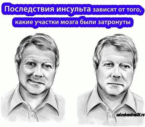 Інсульт: причини і наслідки інсульт у жінок