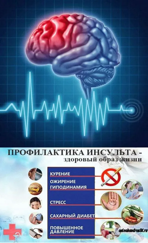 Інсульт: причини і наслідки лікування інсульту