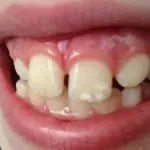 як лікувати абсцес ясен