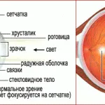 як лікувати короткозорість очей