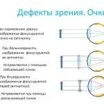 як лікувати короткозорість очей