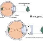 як лікувати короткозорість очей