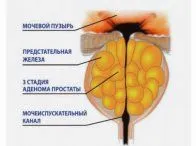 як вилікувати рак легенів 2 стадія