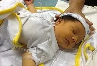 як лікувати жовтяницю у недоношених дітей