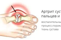 як лікувати розпухлі суглоби