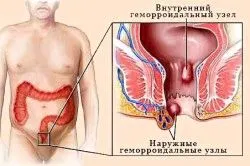 вилікувати геморой самостійно