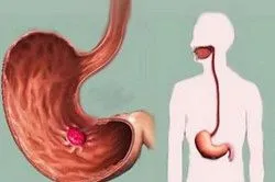 як лікувати кишкову трихомонаду