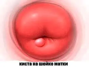 як лікують кісту шийки матки