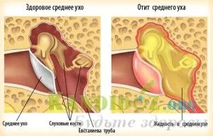 отомікоз