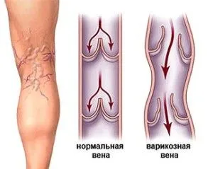 як лікувати варикоз лазером