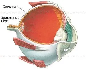неврит очного нерва