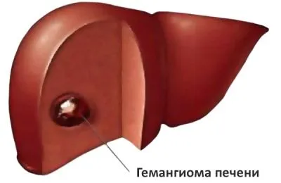 Капілярна гемангіома печінки: що це таке, симптоми і лікування як лікувати гемангиому печінки в домашніх умовах