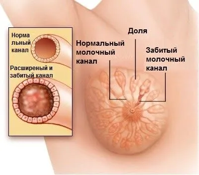 лактостаз мастит молочні залози молоко застій затримка запалення причини симптоми лікування