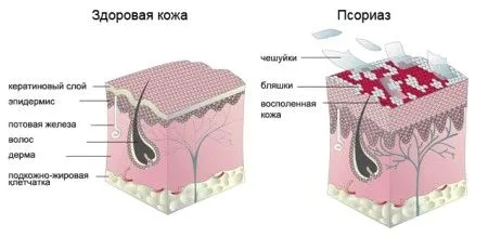 як лікувати псоріаз при вагітності