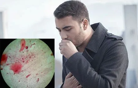 як лікувати мокротиння з кров'ю