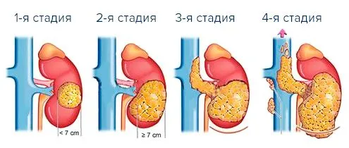 Лікування раку нирки лікування раку нирки