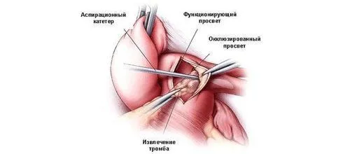 як лікувати судини ніг