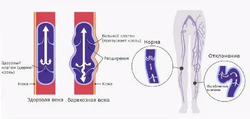 як лікувати судини ніг