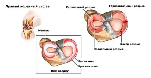 як лікувати меніск в домашніх умовах