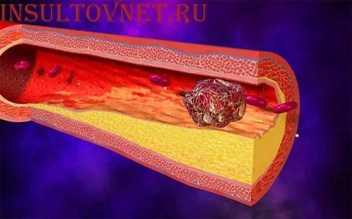лікувати інсульт травами