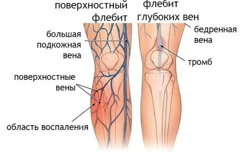 як лікувати судини ніг