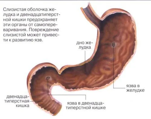 виразка шлунка лікування симптоми як лікувати виразку виразки народні засоби від схема лікування препарати для гостра народними засобами алое при виразці виразкова хвороба лікується захворювань спиртне