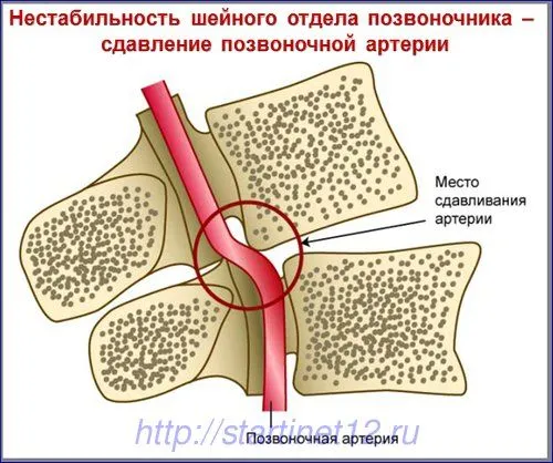 як вилікувати нестабільність шиї