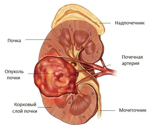 Лікування раку нирки лікування раку нирки