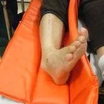 як лікувати розтягнення голеностопа будинку