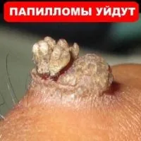 як лікувати вірус папіломи 33