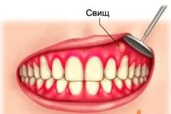як лікувати свищ на яснах у дитини