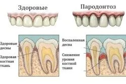як лікувати ясна самостійно