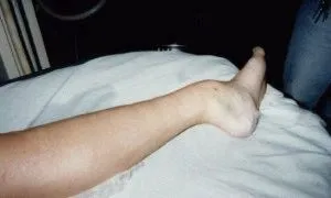 як лікувати розтягування і вивихи