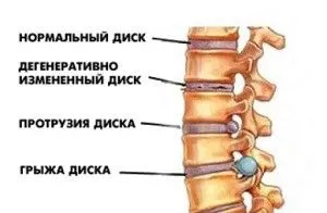 як лікувати ранній остеохондроз