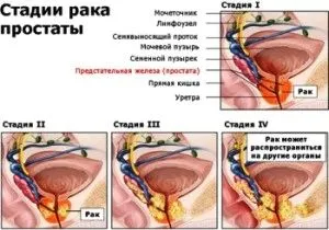 Рак простати 2 ступеня: тривалість життя і прогноз фахівців як лікувати рак 2 ступеня