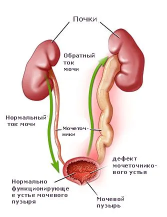 Рефлюкс нирки у дітей: наскільки він небезпечний? як лікувати рефлюкс нирки