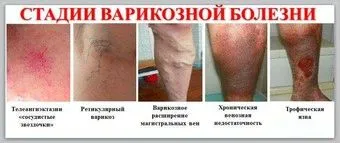 варикоз нога лікування чоловік жінка домашнє умова народний рецепт