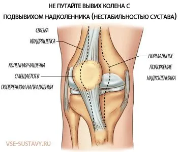 вивих колінного суглоба лікування