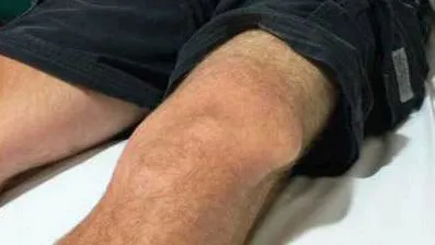 звичний вивих колінного суглоба