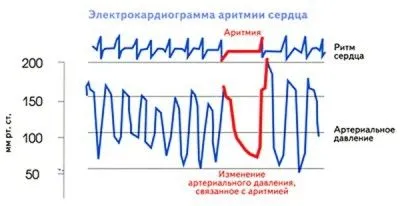 Синусовааритмія серця: причини, симптоми, лікування як лікувати синусоїдальну аритмію