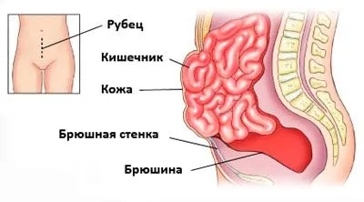 як вилікувати грижу живота без операції