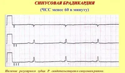 Синусовааритмія серця: причини, симптоми, лікування як лікувати синусоїдальну аритмію