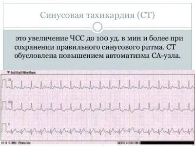 Синусовааритмія серця: причини, симптоми, лікування як лікувати синусоїдальну аритмію
