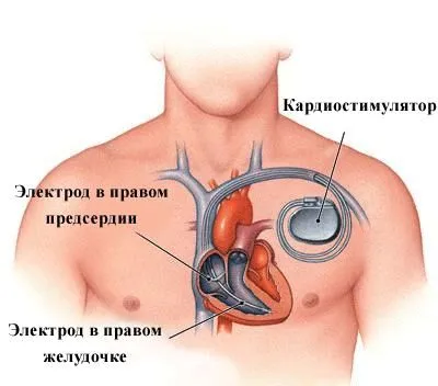 Синусовааритмія серця: причини, симптоми, лікування як лікувати синусоїдальну аритмію